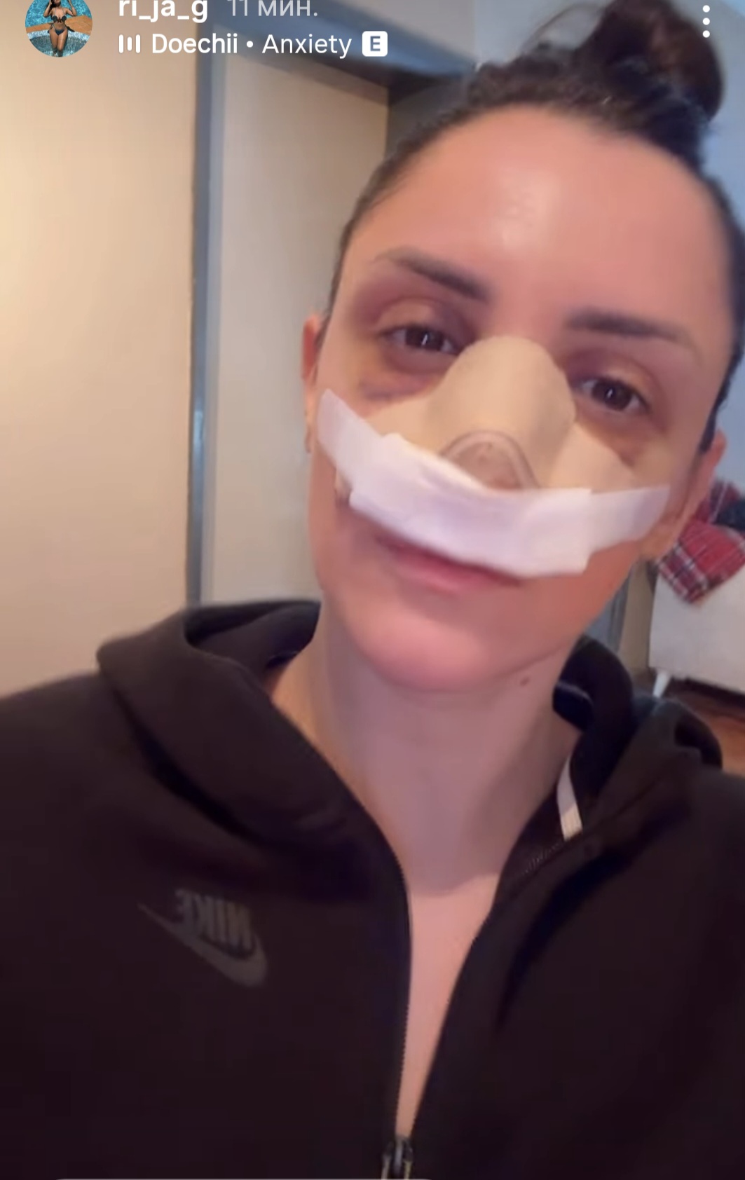 marija gruevska operacija nosa